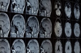 Our Brains Comprise Lithium—and Its Loss May Assist Drive Alzheimer’s, Examine Finds
